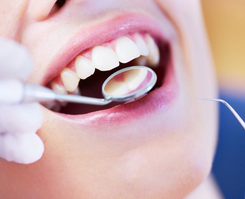 Closeup of a young woman having her healthy white teeth checked for cavities